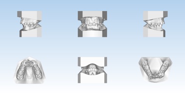 Digitized impressions of the teeth
