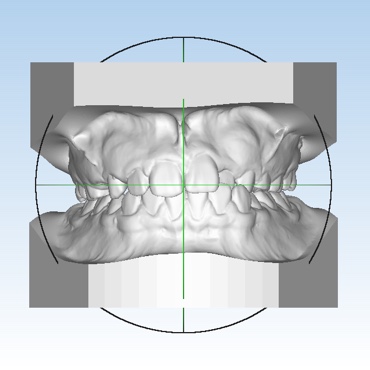 Digitized impressions of the teeth