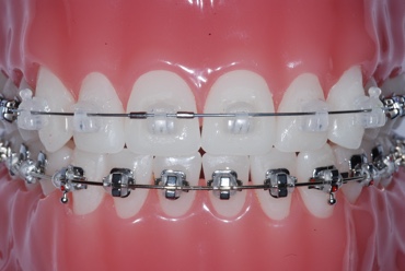 Tie-less Damon&reg; Clear braces on the upper front teeth