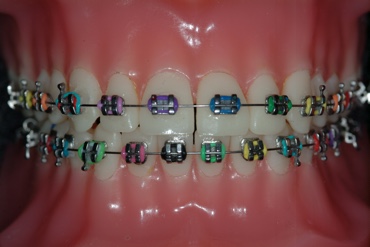 Stainless Steel braces with coloured elastomeric ties