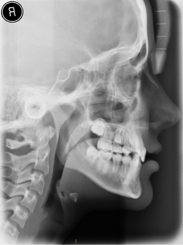 Lateral Cephalometric X-ray of the head