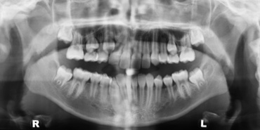 Orthopantomograph X-ray of the teeth and jaws